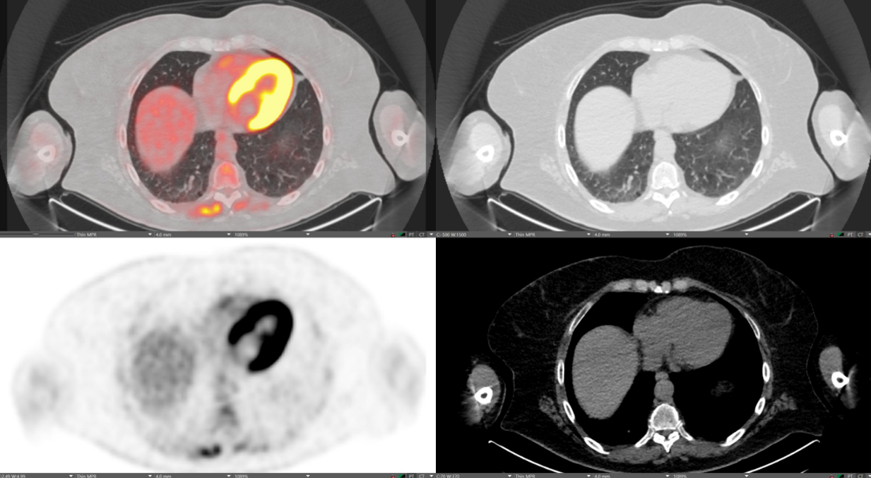 Images of normal myocardial uptake